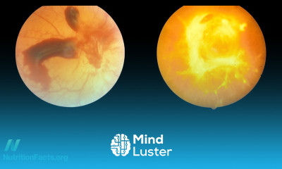 Can Diabetic Retinopathy Be Reversed