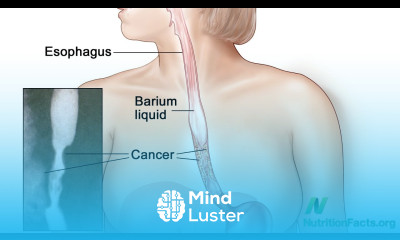 Strawberries versus Esophageal Cancer