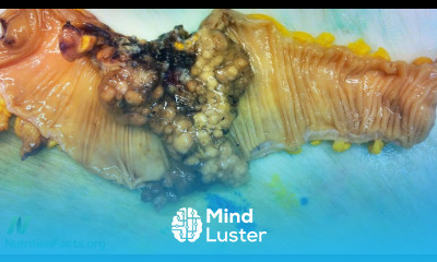 Resistant Starch and Colon Cancer