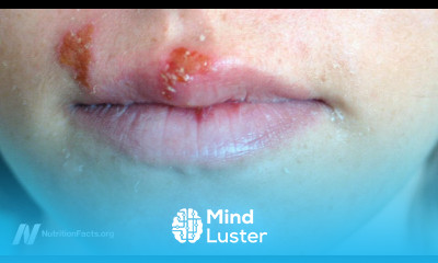 Benefits of Tea Tree Oil For Warts and Cold Sores