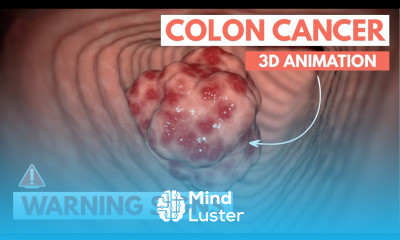 5 warning signs of Colon Cancer 3D Animation