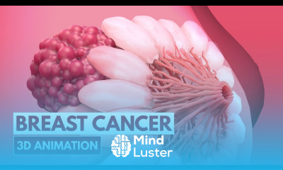 5 Signs of Breast cancer 3D Animation