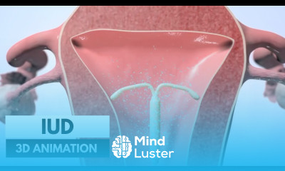 How does an IUD work 3D animation