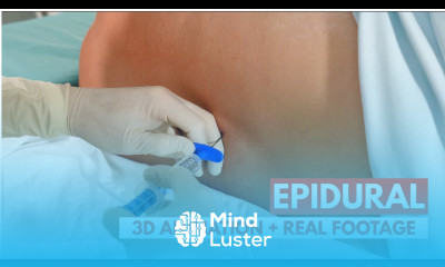 Epidural Anesthesia 3D Animation Real Footage