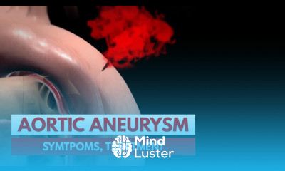 What is an Aortic Aneurysm 3D Animation