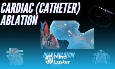 Cardiac Catheter Ablation What is it and how does it help an irregular heart beat