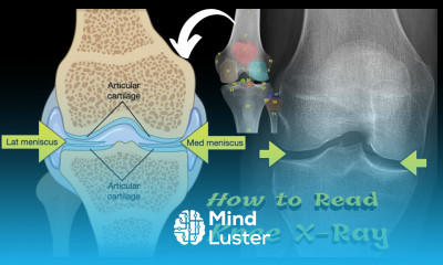 How to Read Knee X Ray Medical Technology