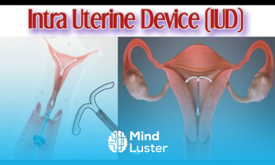 What is IUD Animation For Insertion of IUD Types of IUD