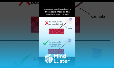 IV Cannulation Technique Tip for Nurses and Nursing Students