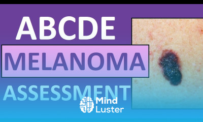 ABCDE Melanoma Skin Cancer Assessment Nursing with Pictures