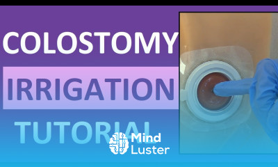 Colostomy Irrigation Procedure Care Ostomy Enema Nursing Stoma Cleaning