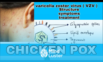 Chicken pox Varicella zoster virus VAZ structure Discovery Symptoms Treatment