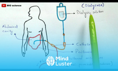 Types of dialysis Intermittent dialysis Peritoneal dialysis Continuous renal replacement