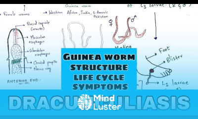 Dracunculiasis Guinea worm Structure Life cycle symptoms treatment Bio science