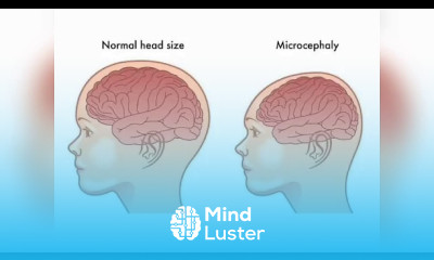 PHENOCOPY AND MICROENEPHALY BY PHANINDRA GUPTHA